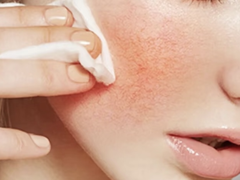 老过敏可能是缺乏维生素！你缺哪种？