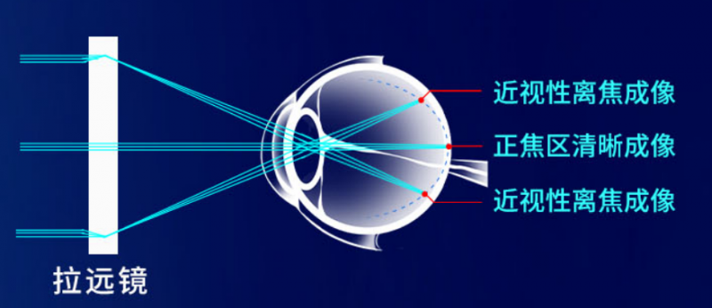 从光学本质出发「拉远镜」将近距离学习转化为「户外远眺」，临床证实有效控制眼轴增长